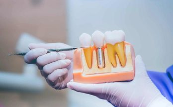 Restoring Confidence and Oral Health with Dental Implants in Boynton Beach, FL