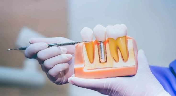 Restoring Confidence and Oral Health with Dental Implants in Boynton Beach, FL
